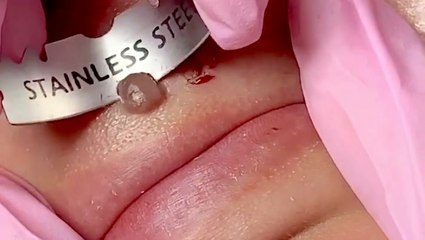 How moles are professionally shaved off