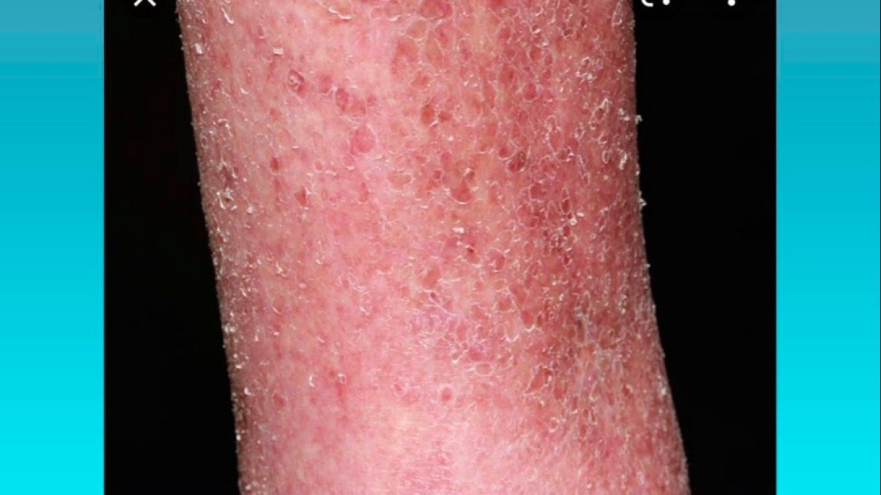 bd-lesiones-mas-comunes-en-la-piel-de-adultos-mayores-030821