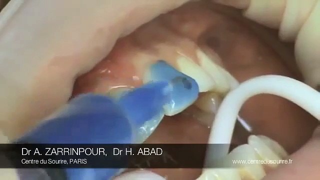 facettes dentaires River8 Caroline Receveur