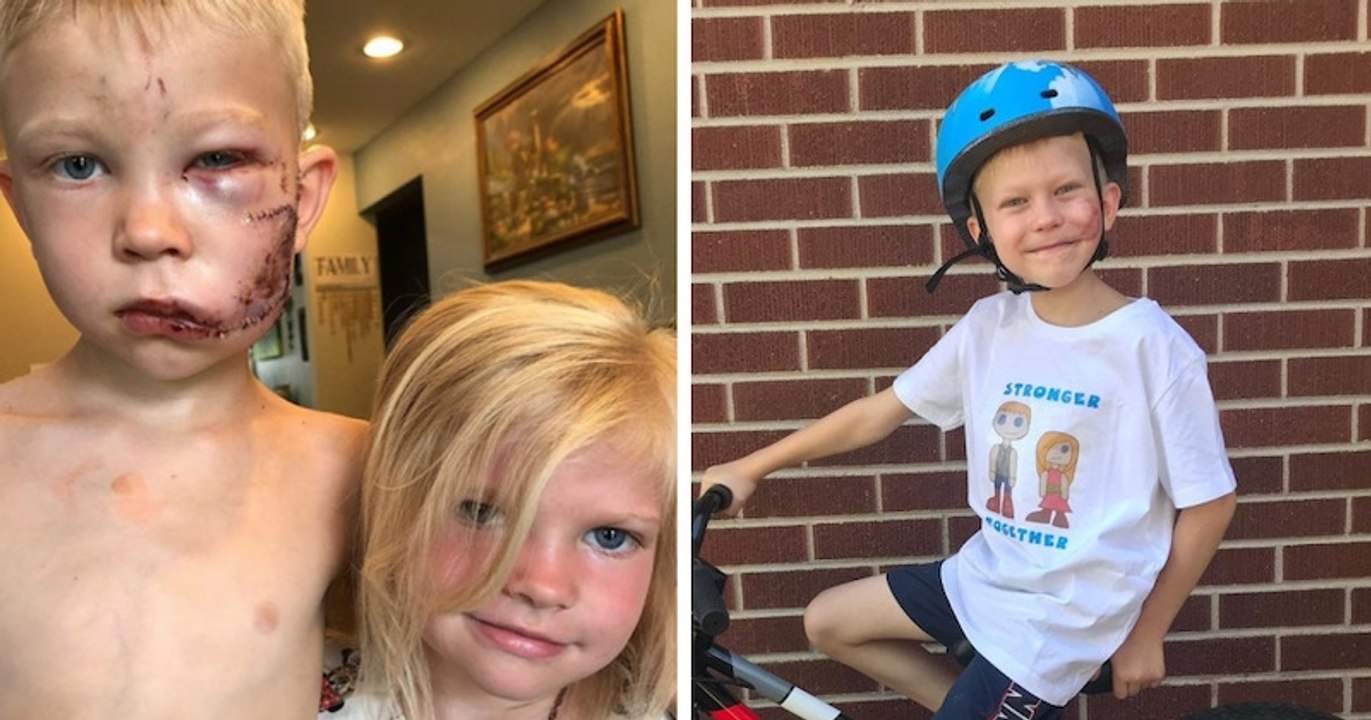 Un petit garçon arbore fièrement sa cicatrice au visage après avoir sauvé sa petite sœur d'une attaque de chien