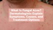 What Is Fungal Acne? Dermatologists Explain Symptoms, Causes, and Treatment Options