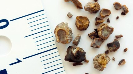 Begini Cara Mengobati Batu Ginjal Yang Disarankan Dokter