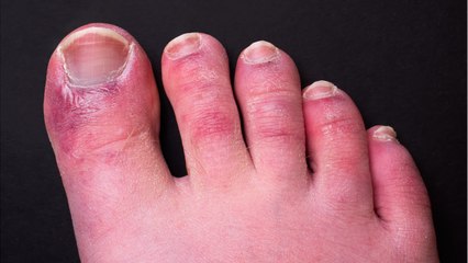 COVID warning: Jab could cause discolouration of toes and fingers