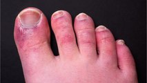 COVID warning: Jab could cause discolouration of toes and fingers