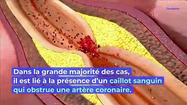 Infarctus : apprenez à reconnaître les symptômes