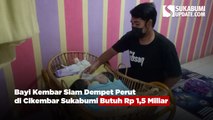 Bayi Kembar Siam Dempet Perut di Cikembar Sukabumi Butuh Rp 1,5 Miliar