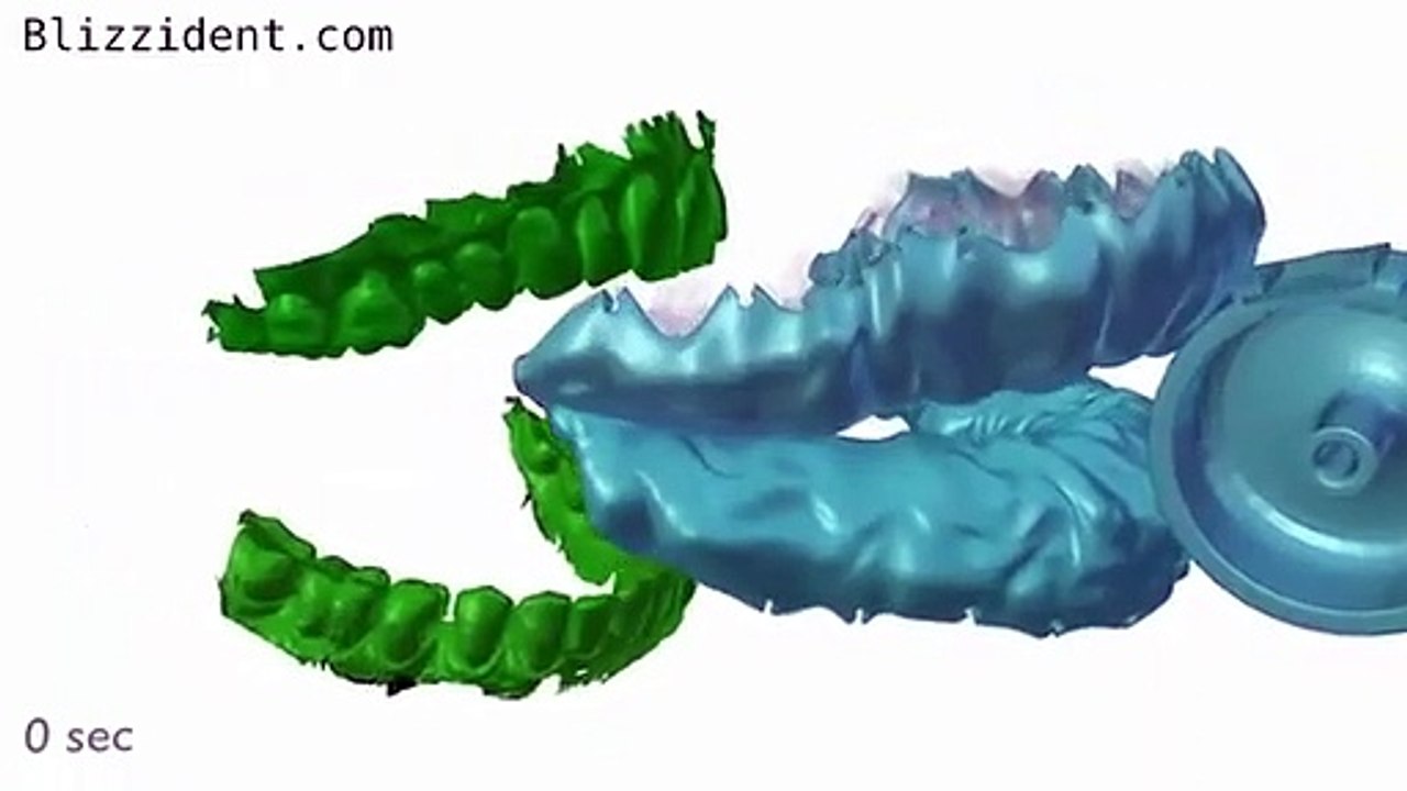 Blizzident, a escova 3D que lava dentes em seis segundos