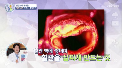 혈관도 살이 찐다! 혈관 비만이 부르는 질병✓ TV CHOSUN 20210812 방송