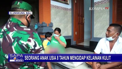 Anak 8 Tahun Menderita Kelainan Kulit Bersisik Sejak Lahir