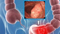 Liver में घाव Ulcerative Colitis एक गंभीर समस्या,समय रहते ऐसे करें पहचान । Boldsky