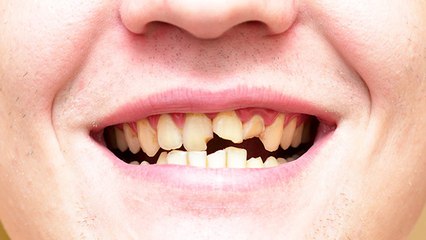 आधा टूटा दांत आपको दे सकता है कई गंभीर बीमारियां,जानें इसका कारण, खतरे और इलाज