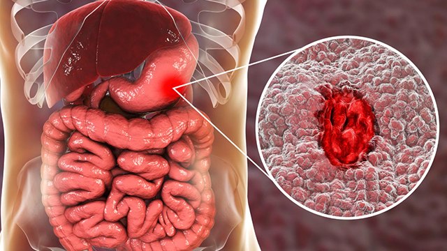 Acidity बार बार होने के कारण हो सकती है गंभीर बीमारी, Peptic Ulcer Disease के जानें कारण और लक्षण