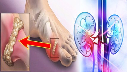 Uric Acid का Kidney पर जानलेवा असर, Doctors Advice | Boldsky