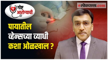 जाणून घ्या । पायातील सूज आणि व्हेन्सच्या व्याधींबद्दल