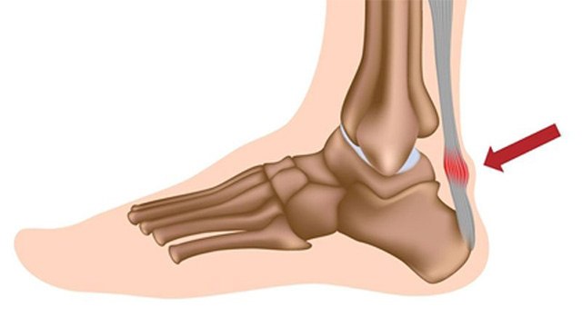 एड़ी में दर्द होने की असली वजह | एड़ी में दर्द क्यों होता है |एड़ी में दर्द हो तो क्या करें |Boldsky