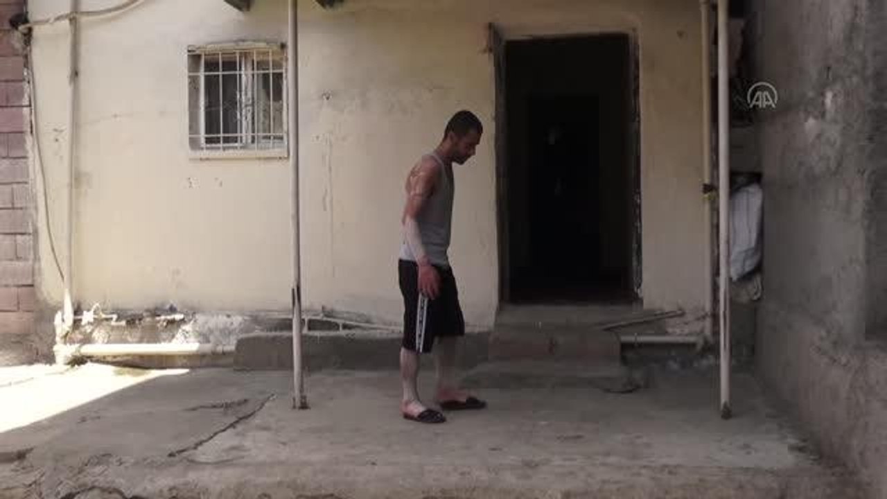 17 yıldır sedef hastalığıyla mücadele eden genç tedavi olmak istiyor