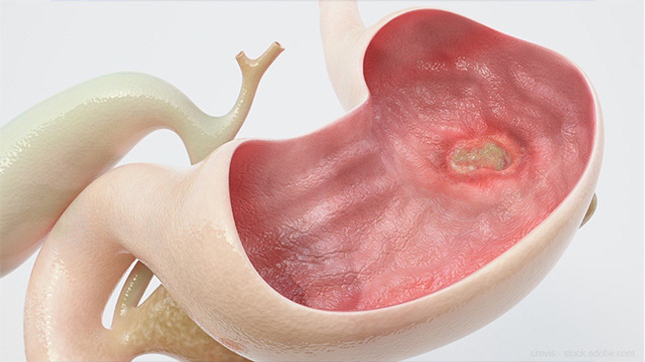 पेट का अल्सर होता है बेहद खतरनाक, जानें लक्षण और घरेलू उपाय । Stomach Ulcer Symptoms । Boldsky