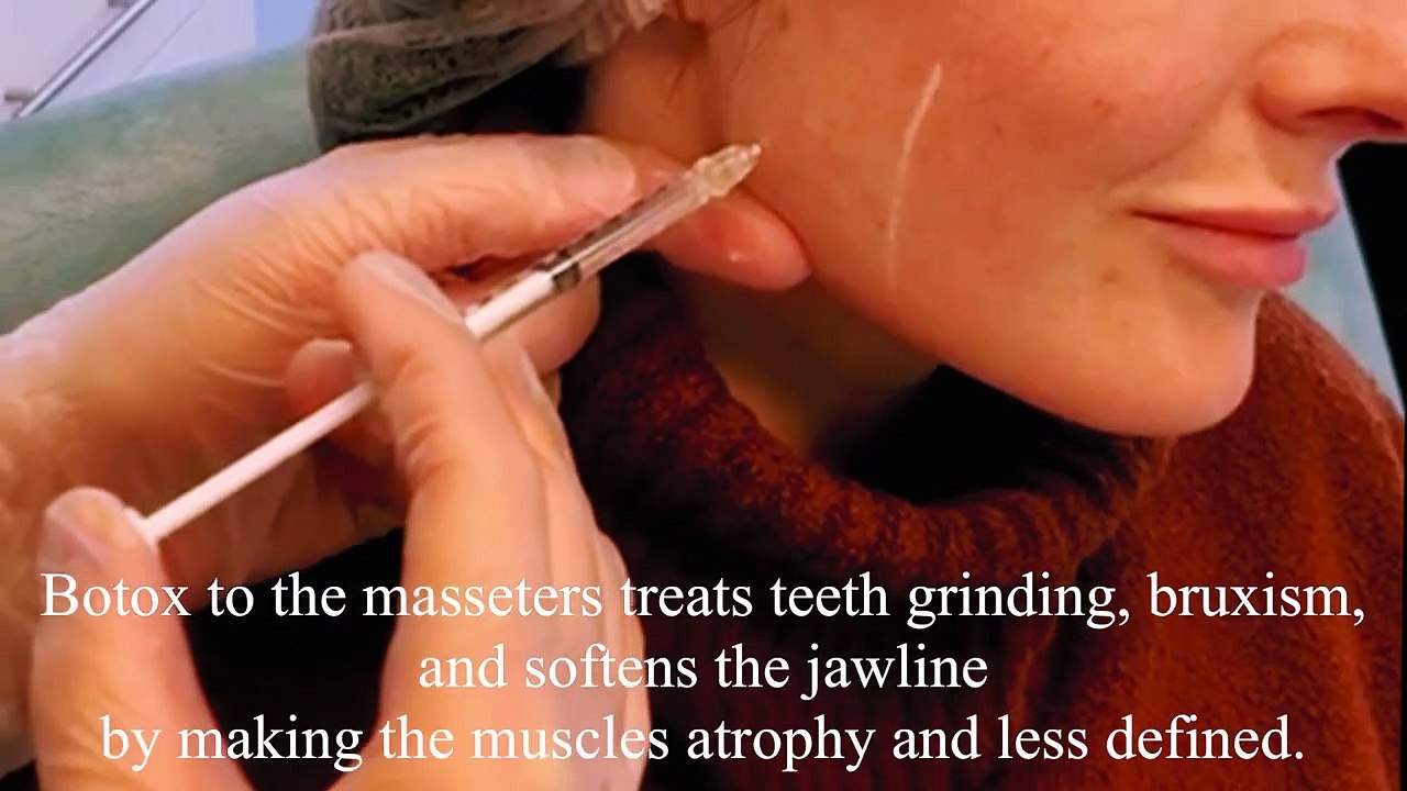 Bodyvie Medi-Clinic_ Botox for the Masseters to Treat Teeth Grinding