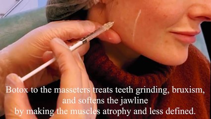 Bodyvie Medi-Clinic_ Botox for the Masseters to Treat Teeth Grinding