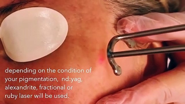 Bodyvie Medi-Clinic: Laser Pigmentation and Sunspot Removal