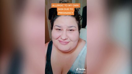 Ella es Ashton Brown, una mujer que es alérgica a su propia piel