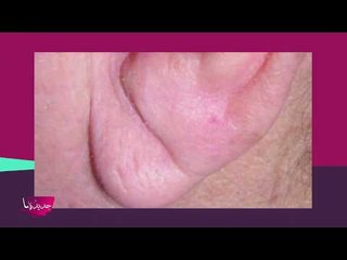 شحمة الأذن قد تكشف إصابتكم بأمراض خطيرة .. هذا ما عليكم فعله في هذه الحالة !!