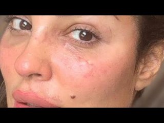 نادين نجيم فشلت في إخفاء جروحها! جرح كبير في خدها بحاجة إلى عملية تجميل !