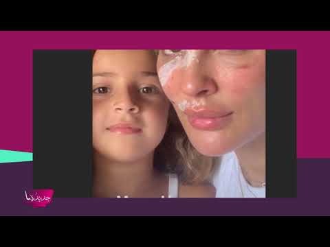 هجوم على قصي خولي بسبب صورة نادين نجيم التي كشفت فيها عن جروح وجهها !! وهذا ما قالته أحلام