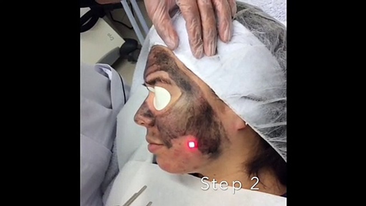 Carbon Facial - Problem Skin