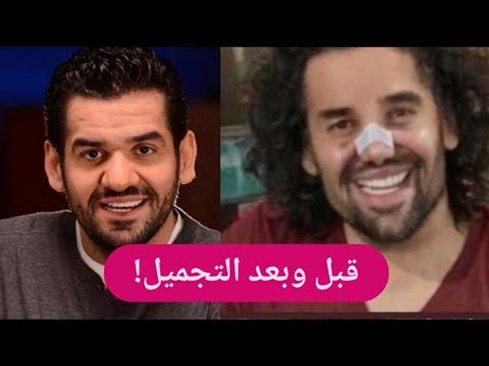 اول تعليق لـ حسين الجسمي بعد خضوعه لـ عملية تجميل الأنف .. ملامحه صادمة !!