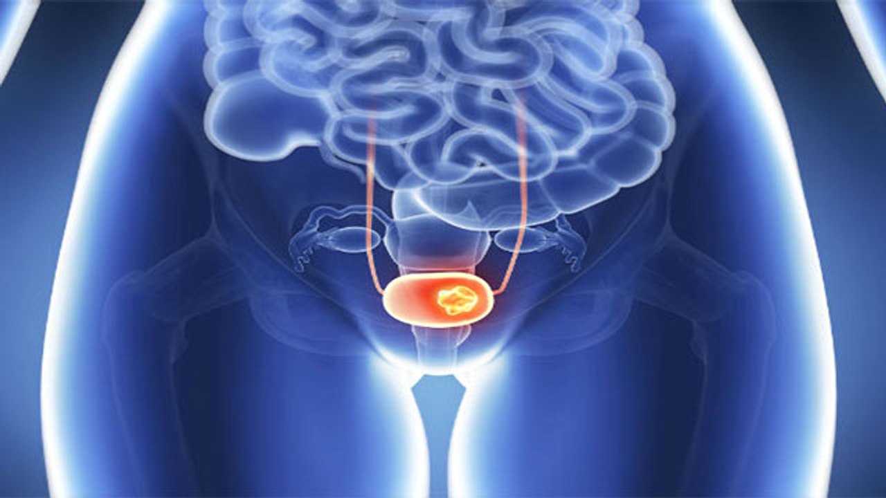 Urinary Bladder Cancer क्या है, चौंकाने वाले Symptoms और जाने Treatment | Boldsky