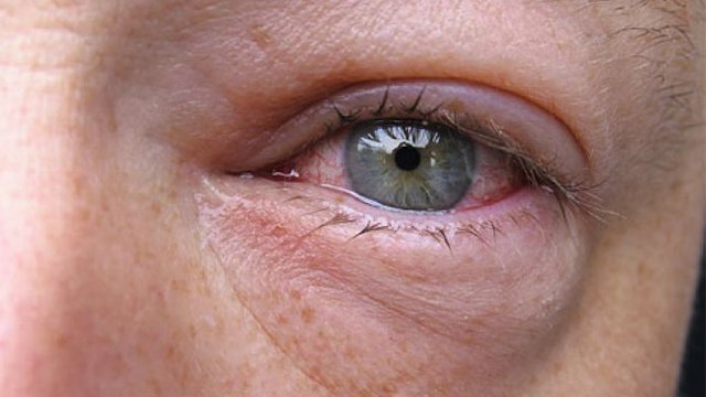 Morning में उठते ही Face में रहती ही Swelling, तो इस बीमारी का है संकेत | Boldsky