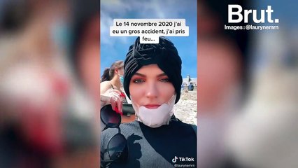 "J'ai mis 3-4 mois à découvrir mon corps en entier" : grande brûlée, elle témoigne