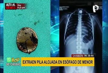 Chimbote: extraen pila alojada en el esófago de una niña