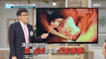 [HEALTHY] Colon polyps, if you don't remove them, they become seeds of cancer?!, 기분 좋은 날 210826