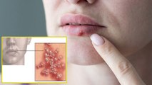 Lips के पास पानी भरे लाल दाने हो सकते हैं 'Cold Sores', जानें इसके कारण, लक्षण और इलाज के उपाय