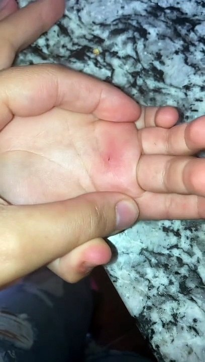 Simple Trick to Suck Out Splinters
