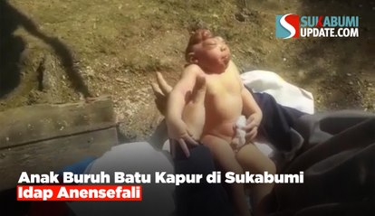 Anak Buruh Batu Kapur di Sukabumi Idap Anensefali