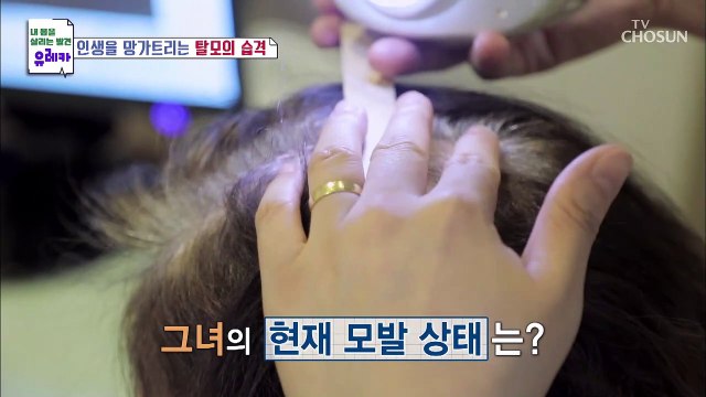 탈모 20년째인 그녀의 현재 모발 상태는? TV CHOSUN 20210829 방송