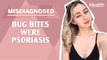This Woman's Psoriasis Was Misdiagnosed as Bug Bites | Misdiagnosed: Claire Spurgin | Health.com