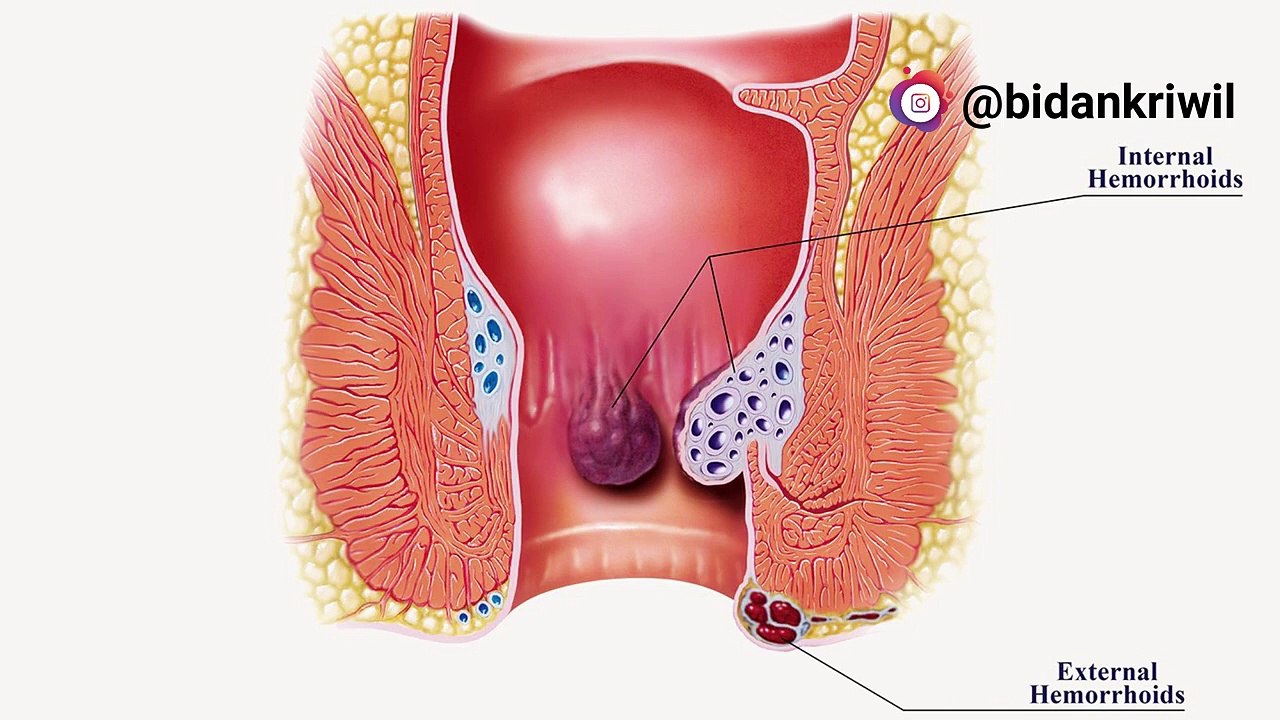 WASIR_ AMBEIEN _ HEMOROID SETELAH MELAHIRKAN