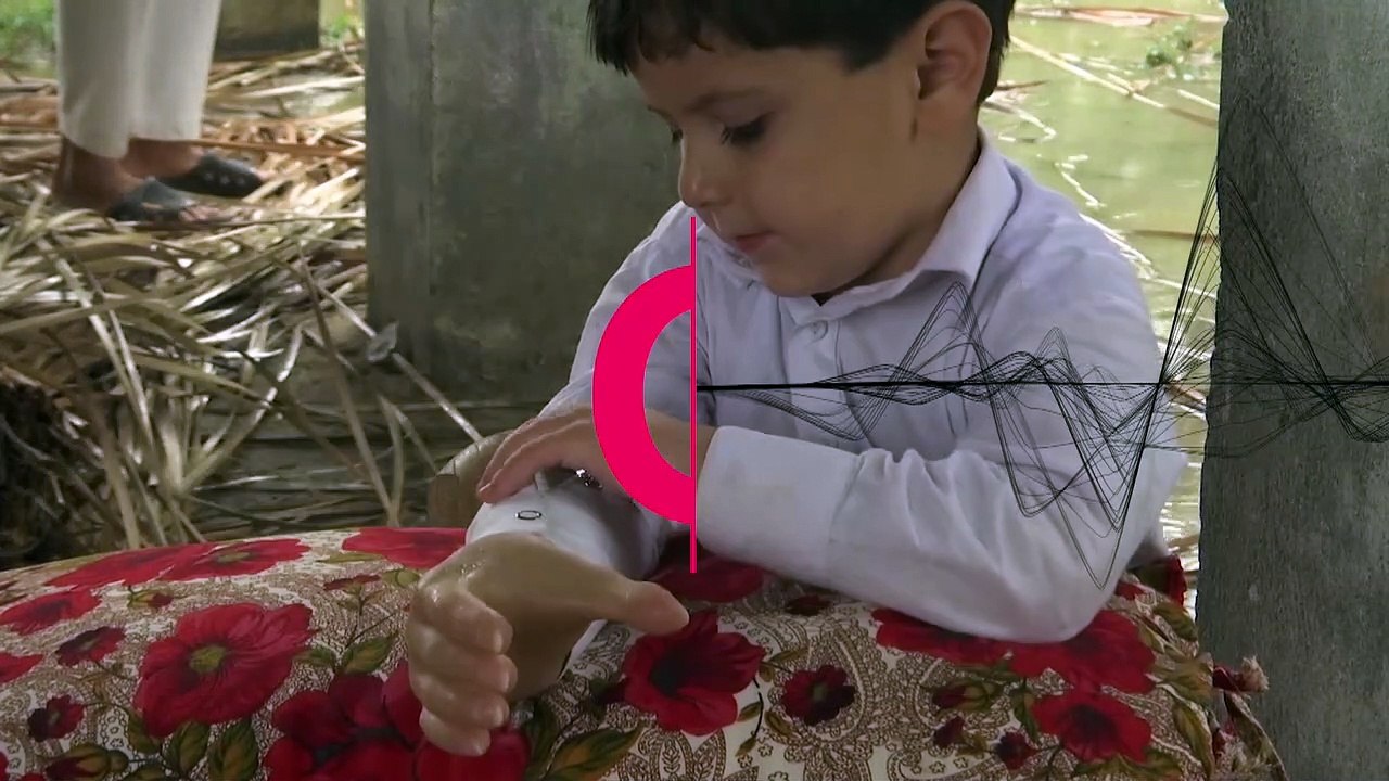 Vierjähriger Junge aus Pakistan mit bionischer Armprothese