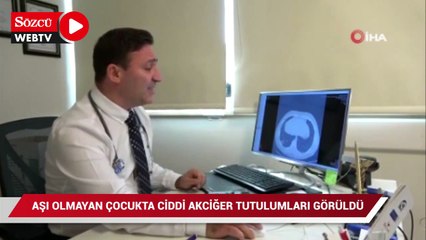 Aşı olmayan 14 yaşındaki çocukta ciddi akciğer tutulumları görüldü