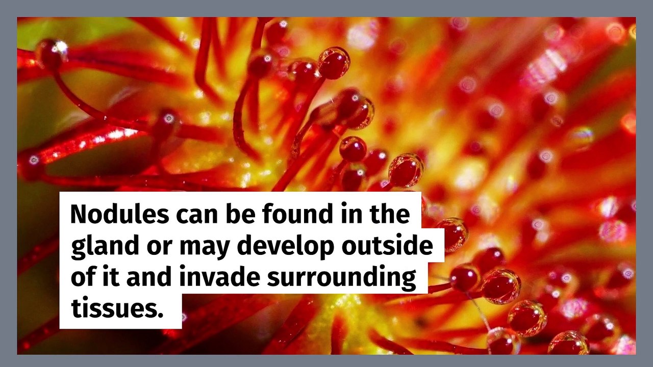 What is thyroid RFA (Radiofrequency Ablation)