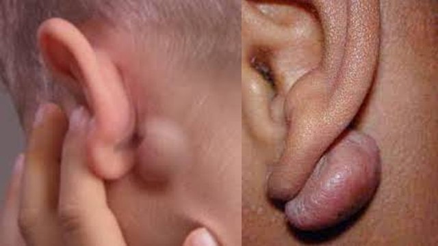 कान में हड्डी बढ़ना है बेहद खतरनाक जानिए लक्षण, कारण और उपाय । Boldsky