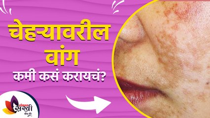 चेहऱ्यावरील वांग जाण्यासाठी घरगुती उपाय | Home Remedies for Pigmentation on Face | Lokmat Sakhi