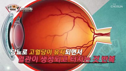 눈앞에서 평생 사라지지 않는 검은점 당뇨망막병증 TV CHOSUN 210906 방송