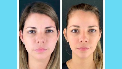 bd-cachetes-grandes-o-bruxisno-060921