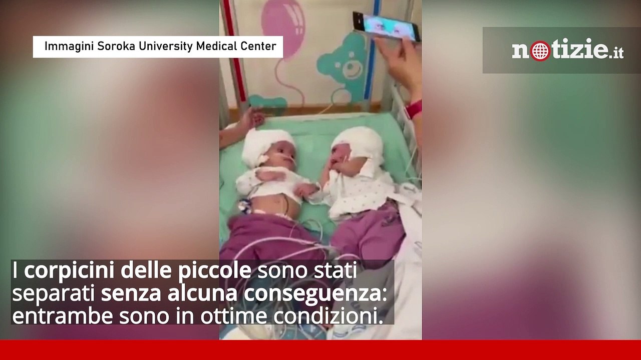 Israele, separate gemelle siamesi attaccate per la testa: si guardano in faccia per la prima volta