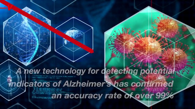 Artificial Intelligence Algorithms Confirm a 99% Accuracy of Detecting Potential Alzheimer's Disease